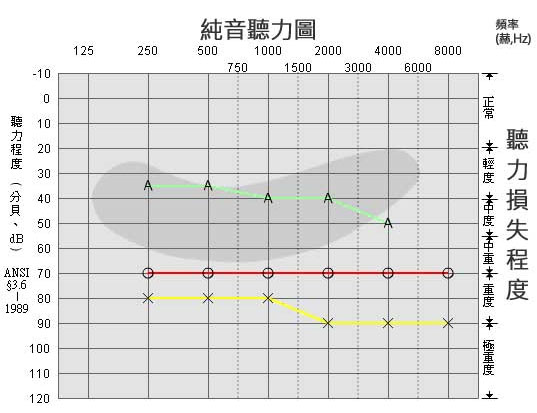 純音測試圖怎么看[純音測試結果怎么看]