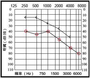 什么是助聽器通道[聽器通道什么]