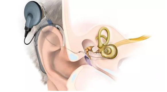 美國人工耳蝸介紹-美國人工耳蝸官網