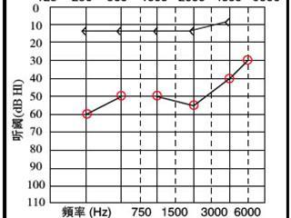 助聽器能恢復(fù)聽力嗎